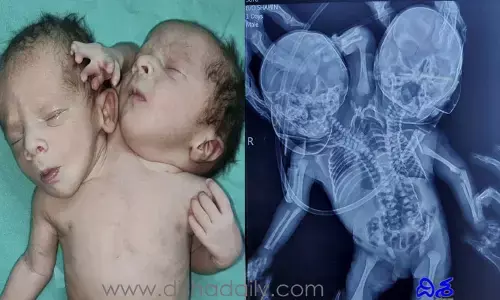 రెండు తలలు, మూడు చేతులతో జన్మించిన శిశువు