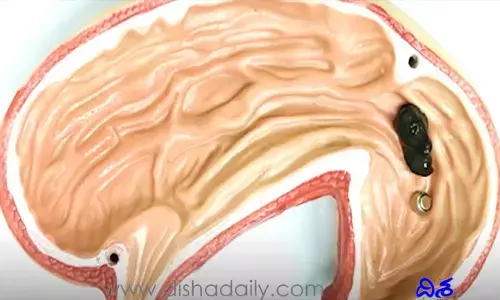 స‌రికొత్త ఆవిష్క‌ర‌ణః శ‌రీరంలో ఎక్క‌డికైన దూర‌గ‌లిగే మ్యాగ్న‌టిక్ సాఫ్ట్ రోబో (వీడియో)