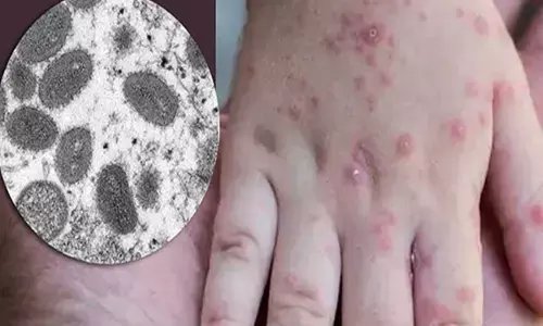 Indias Second Monkeypox Case Confirmed in Kerala