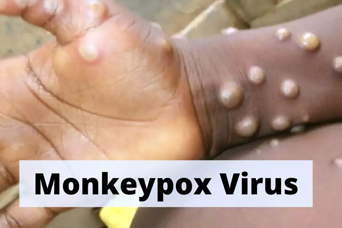 Center Emergency meeting to Contain Spread of Monkeypox Infection