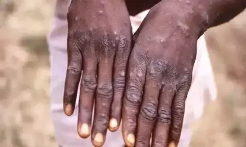 US Declares Monkeypox a Public Health Emergency