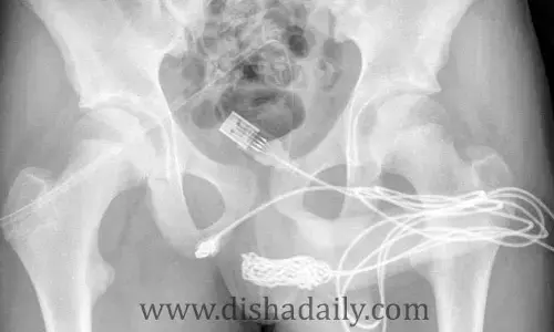 పీనిస్‌లో చిక్కుకున్న యూఎస్‌బీ కేబుల్.. ప్రైవేట్ పార్ట్స్ కొలుస్తుండగా