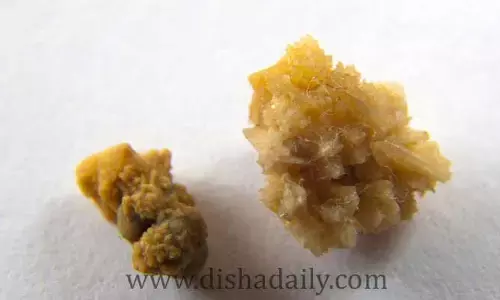 Kidney Stones : కిడ్నీల్లో రాళ్లు ఎందుకొస్తాయో.. తెలుసా ?