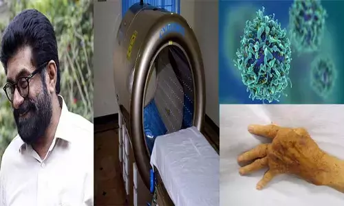 Cancer Treatment: క్యాన్సర్ చికిత్సలో ముందడుగు