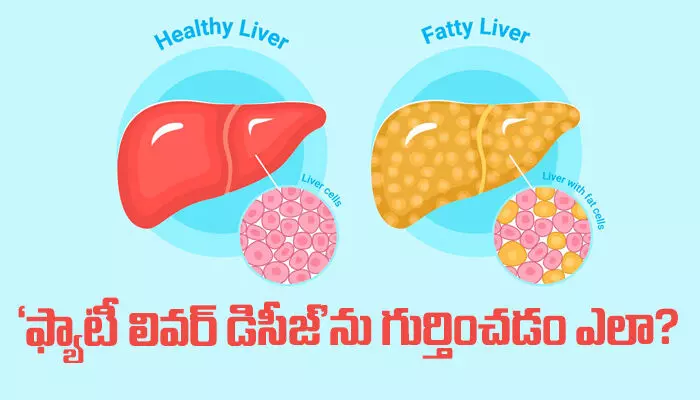 Fatty liver disease : ఫ్యాటీ లివర్ డిసీజ్‌ను గుర్తించడం ఎలా?