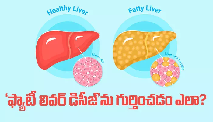 Fatty liver disease : ఫ్యాటీ లివర్ డిసీజ్ను గుర్తించడం ఎలా? Fatty liver disease : ఫ్యాటీ లివర్ డిసీజ్ను గుర్తించడం ఎలా?