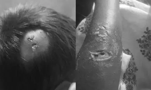 హైదర్ గూడలో ఐదుగురి పై పిచ్చికుక్క దాడి..