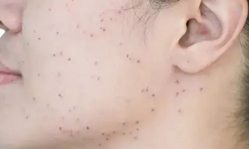 Black Spots: వీటితో బ్లాక్ స్పాట్స్ ఈజీగా మాయం చేయవచ్చు!