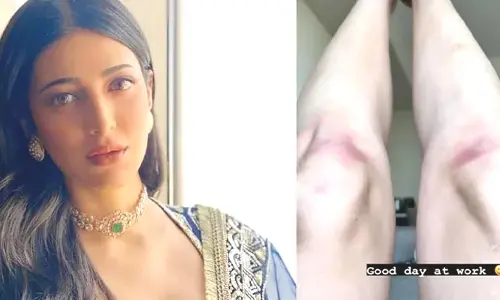 Shruti Haasan: అది డాగీ స్టైల్ ఎఫెక్టే.. శృతి మోకాళ్ల గాయంపై ట్రోలింగ్