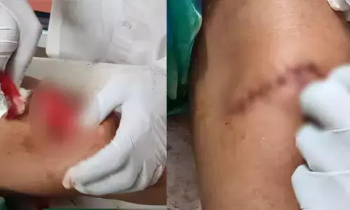 ప్రభుత్వ ఆసుపత్రిలో వైద్యుల నిర్లక్ష్యం... గాయంలోని రాళ్లు తీయకుండానే కుట్లు