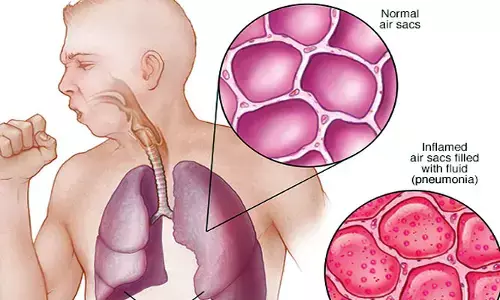 Pneumonia : ఆ లక్షణాలు కనిపిస్తున్నాయా?.. అయితే న్యుమోనియా కావచ్చు!
