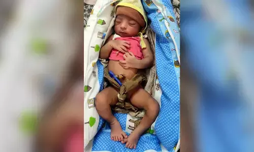 వింత ఘటన.. 24 వేళ్ళతో జన్మించిన శిశువు
