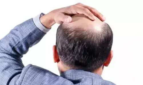 మగవారికే బట్టతల ఎందుకు వస్తుందో తెలుసా?