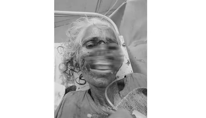 కుక్క దాడిలో తీవ్రంగా గాయపడిన వృద్ధురాలు.. పరిస్థితి విషమం కుక్క దాడిలో తీవ్రంగా గాయపడిన వృద్ధురాలు.. పరిస్థితి విషమం