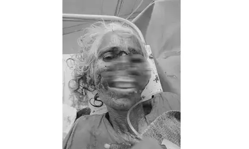 కుక్క దాడిలో తీవ్రంగా గాయపడిన వృద్ధురాలు.. పరిస్థితి విషమం
