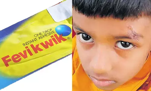 గాయానికి కుట్లకు బదులు ఫెవిక్విక్‌తో అతికించిన డాక్టర్ (వీడియో)