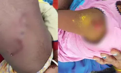 పిచ్చికుక్క దాడిలో పలువురికి గాయాలు..