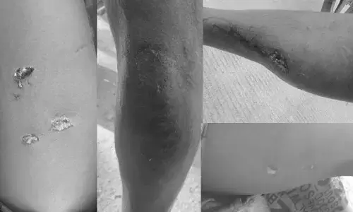పిచ్చికుక్క దాడిలో ఏడుగురికి గాయాలు..