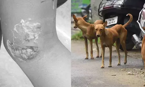 Vijayawada: రెచ్చిపోయిన కుక్కలు.. వెంటపడి మరీ చిన్నారిపై దాడి