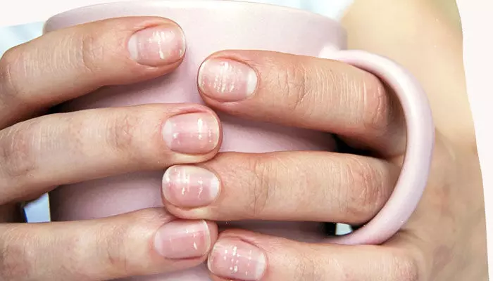 Health Tips : గోర్లపై తెల్ల మచ్చలు.. ఎందుకొస్తాయో తెలుసా? Health Tips : గోర్లపై తెల్ల మచ్చలు.. ఎందుకొస్తాయో తెలుసా?