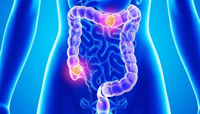 COLON CANCER : పెద్ద పేగు క్యాన్సర్ లక్షణాలు.. అస్సలు లైట్ తీసుకోవద్దు.. COLON CANCER : పెద్ద పేగు క్యాన్సర్ లక్షణాలు.. అస్సలు లైట్ తీసుకోవద్దు..