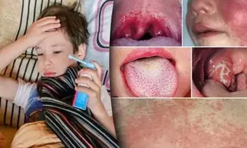 Scarlet Fever: వణికిస్తున్న స్కార్లెట్‌ జ్వరం.. లక్షణాలు ఇవే..!