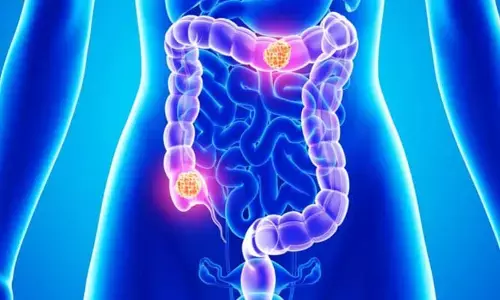 COLON CANCER : పెద్ద పేగు క్యాన్సర్ లక్షణాలు.. అస్సలు లైట్ తీసుకోవద్దు..