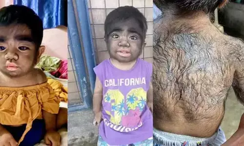 ఇదేం వింత జబ్బురా నాయనా.. ఎలుగుబంటిలా మారుతున్న బాలుడు..