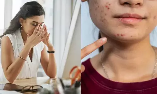 మానసిక ఒత్తిడితో స్కిన్ ప్రాబ్లమ్స్.. మొహంపై మొటిమలు కూడా అందుకే వస్తాయా?