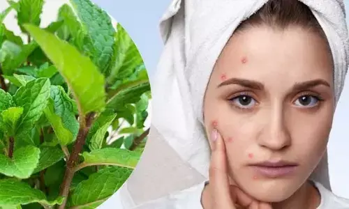 పుదీనాతో మొటిమలకు చెక్.. ఎలాగో చూడండి..