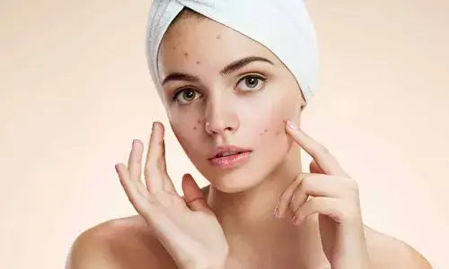 Acne: మొటిమలను గోళ్లతో గిల్లుతున్నారా? మచ్చలకే కాదు.. మరిన్ని సమస్యలకు దారితీస్తుంది..!