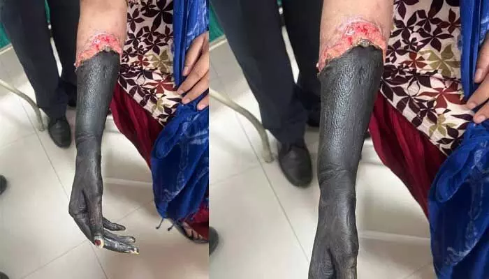 Pain Killer:పెళ్లి ఆపిన పెయిన్ కిల్లర్ ఇంజక్షన్.. Pain Killer:పెళ్లి ఆపిన పెయిన్ కిల్లర్ ఇంజక్షన్..
