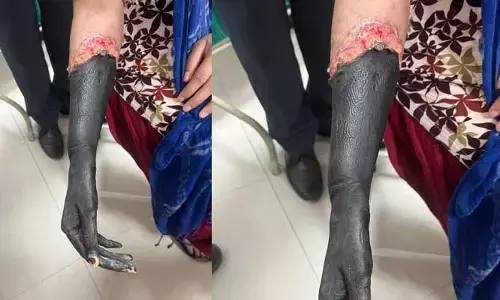 Pain Killer:పెళ్లి ఆపిన పెయిన్ కిల్లర్ ఇంజక్షన్..
