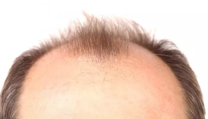 Hair Fall : బట్టతల సమస్య పురుషుల్లోనే ఎందుకు వస్తుంది?.. అసలు కారణం అదేనా! Hair Fall : బట్టతల సమస్య పురుషుల్లోనే ఎందుకు వస్తుంది?.. అసలు కారణం అదేనా!