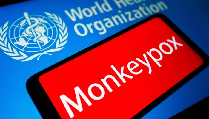Monkeypox: మంకీపాక్స్ కొత్త కొవిడ్ కాదు.. ఎలా నియంత్రించాలో తెలుసు: WHO Monkeypox: మంకీపాక్స్ కొత్త కొవిడ్ కాదు.. ఎలా నియంత్రించాలో తెలుసు: WHO