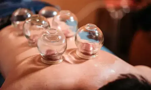 cupping therapy : కప్పింగ్ థెరపీ అంటే ఏమిటి.. చర్మం, ఆరోగ్యం రెండింటికీ ఎలా మేలు చేస్తుంది..