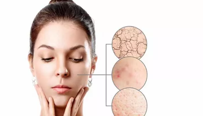 Skin care Tips: ప్యాచీ స్కిన్ పోగొట్టే బెస్ట్ రెమిడీస్..! Skin care Tips: ప్యాచీ స్కిన్ పోగొట్టే బెస్ట్ రెమిడీస్..!