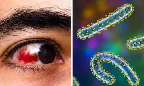 Bleeding eye virus : ముంచుకొస్తున్న ముప్పు..! ప్రాణాంతకంగా మారుతున్న బ్లీడింగ్ ఐ వైరస్