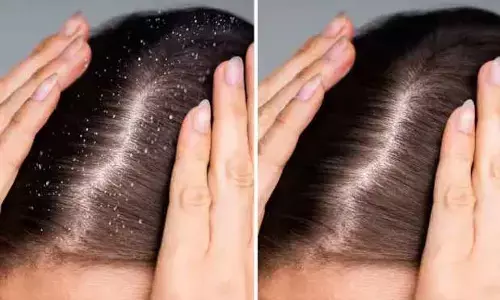 Dandruff : చలికాలంలో చుండ్రు సమస్య.. సొల్యూషన్ ఇదిగో!
