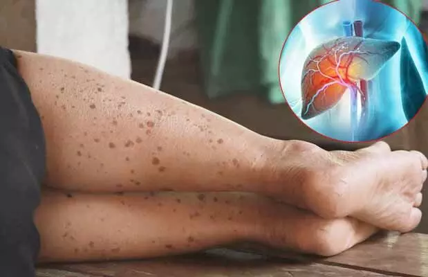Liver health : పాదాలపై బ్రౌన్ కలర్ మచ్చలా..? లివర్లో ఆ సమస్యకు సంకేతం కావచ్చు! Liver health : పాదాలపై బ్రౌన్ కలర్ మచ్చలా..? లివర్లో ఆ సమస్యకు సంకేతం కావచ్చు!