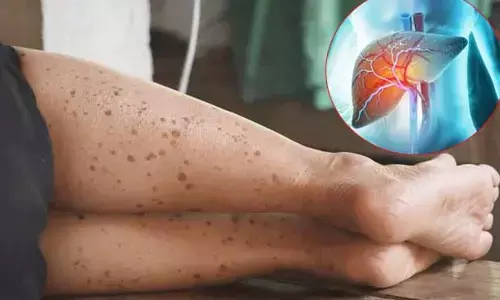 Liver health : పాదాలపై బ్రౌన్ కలర్ మచ్చలా..? లివర్‌‌లో ఆ సమస్యకు సంకేతం కావచ్చు!
