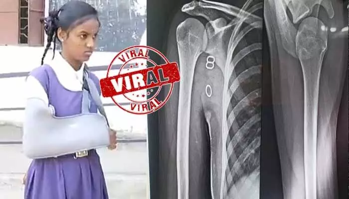 Trending: ప్రభుత్వ పాఠశాలలో అమానుషం.. విద్యార్థిని చెయ్యి విరిగేలా కొట్టిన టీచర్ Trending: ప్రభుత్వ పాఠశాలలో అమానుషం.. విద్యార్థిని చెయ్యి విరిగేలా కొట్టిన టీచర్