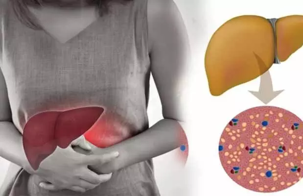 Health : యువతలోనూ ఫ్యాటీ లివర్ ప్రాబ్లమ్స్..! ఎలా గుర్తించాలి? Health : యువతలోనూ ఫ్యాటీ లివర్ ప్రాబ్లమ్స్..! ఎలా గుర్తించాలి?