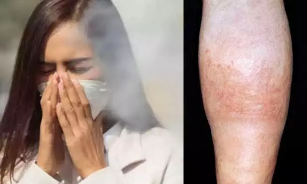 Air pollution : వామ్మో వాయు కాలుష్యం.. సిరల్లో రక్తం గడ్డ కట్టేచాన్స్! Air pollution : వామ్మో వాయు కాలుష్యం.. సిరల్లో రక్తం గడ్డ కట్టేచాన్స్!
