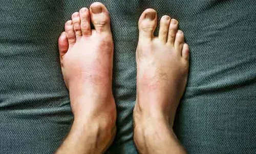 తరచూ మీ బాడీలో మంట, వాపుకు కారణమయ్యే ఫుడ్స్?
