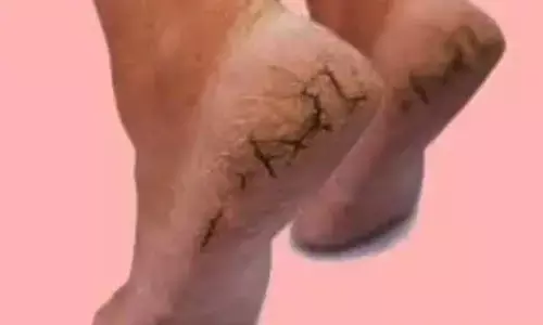 Health Tips : కాలిమడమల్లో పగుళ్లు.. ఈ రెమెడీస్‌ ట్రై చేసి చూడండి!