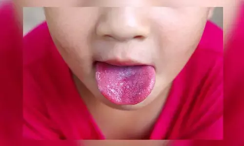 Scarlet Fever : హైదరాబాద్ లో పెరుగుతున్న పిల్లల స్కార్లెట్ జ్వరం కేసులు