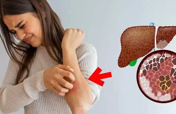 Fatty Liver : ముఖంలో వాపు, శరీరంపై దురద.. ఈ వ్యాధి సంకేతం కావచ్చు! Fatty Liver : ముఖంలో వాపు, శరీరంపై దురద.. ఈ వ్యాధి సంకేతం కావచ్చు!