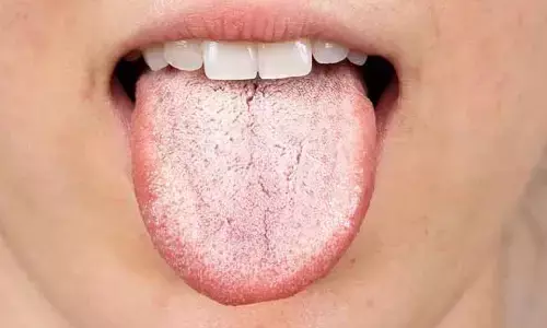 Tongue : వామ్మో.. నాలుకపై ఆ మచ్చలా..? ఏం జరుగుతుందో తెలుసా?