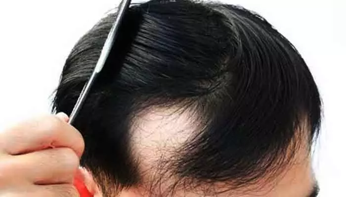 Baldness: చిన్న ఏజ్లోనే బట్టతల రావడానికి కారణాలు..నిపుణులు ఏం చెబుతున్నారంటే? Baldness: చిన్న ఏజ్లోనే బట్టతల రావడానికి కారణాలు..నిపుణులు ఏం చెబుతున్నారంటే?